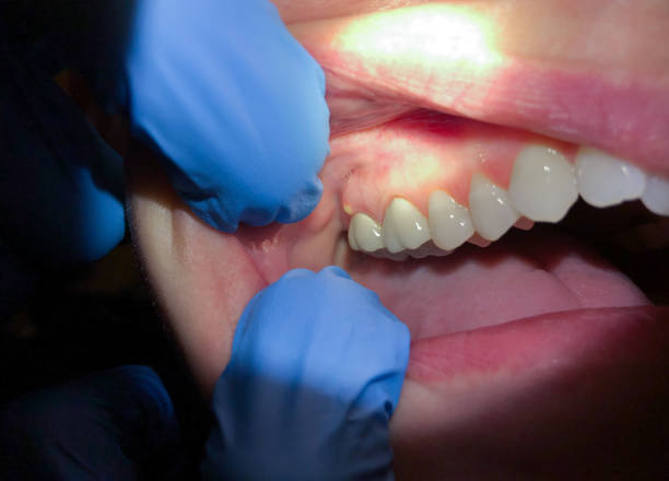 Best Emergency Treatment for Dental Infections or Abscesses in Woodland, CA