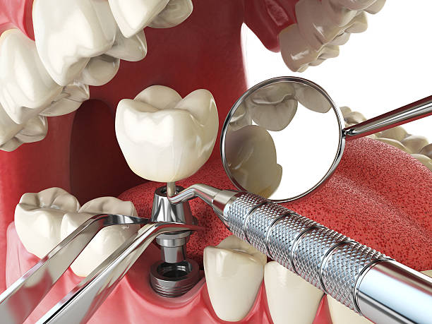 Best Emergency Treatment for Dental Infections or Abscesses in Woodland, CA